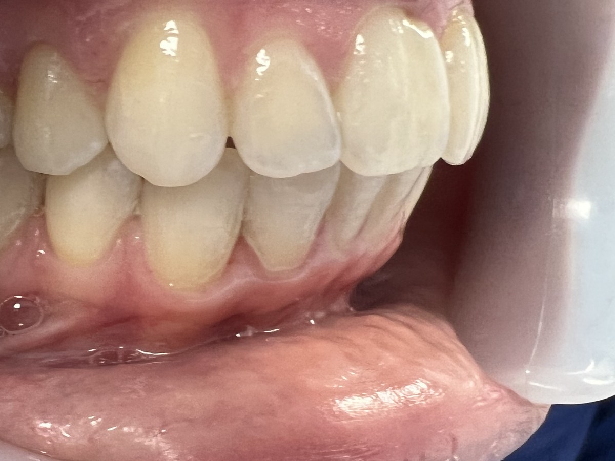The same lower front teeth aligned at the end of clear aligner treatment