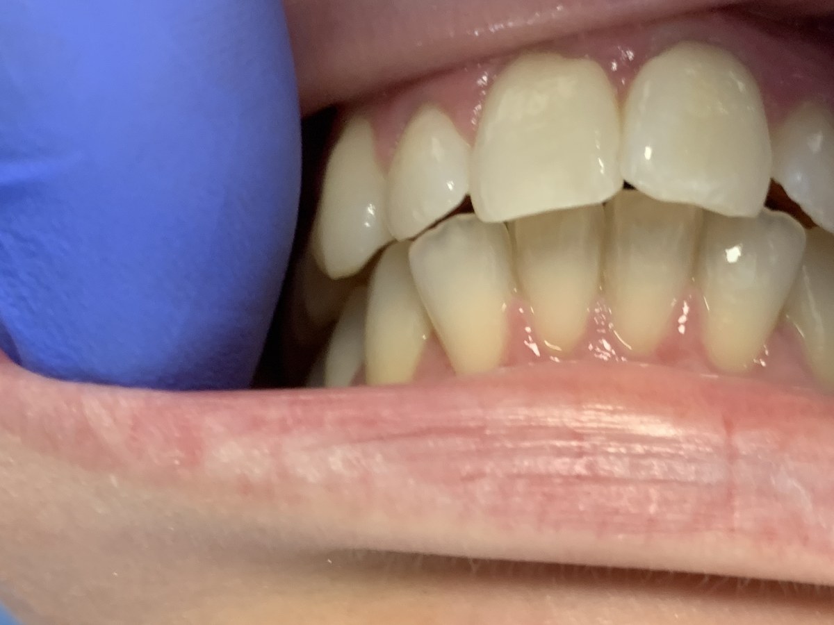 Crowded and overlapping lower front teeth before clear aligner treatment